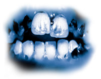 Os ingredientes tóxicos de meth levam a uma deterioração dentária severa conhecida como “boca de meth”. Os dentes ficam pretos, manchados e deterioram, frequentemente até ao ponto de precisarem de serem extraídos. Os dentes e as gengivas são destruídos de dentro para fora e as raízes deterioram–se.